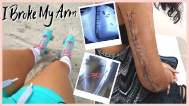 VIDEO: I broke my arm! BAD!