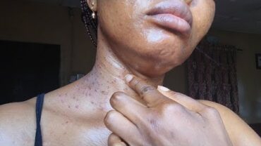 VIDEO: See How I Removed My Skin Tags In Lagos, Nigeria | Who sent me? | Flo Chinyere